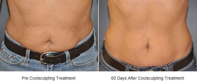 CoolSculpting® Before and After Patient