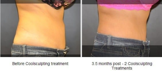 CoolSculpting Before and After Picture of Lower Abdomen - Connecticut Skin  Institute