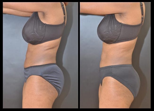 CoolSculpting Before and After Picture of Female Lower Abdomen
