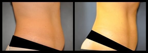 CoolSculpting Before and After Picture of Back Fat and Stomach -  Connecticut Skin Institute