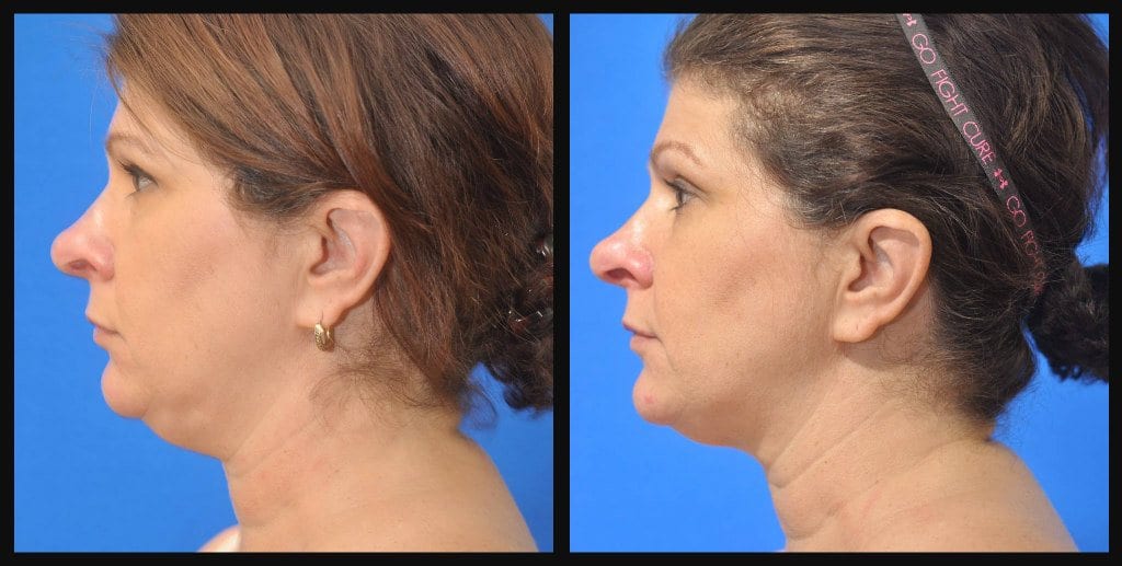 Real Results of Coolsculpting (Before/After Photos) - NOVA Plastic Surgery  and Dermatology