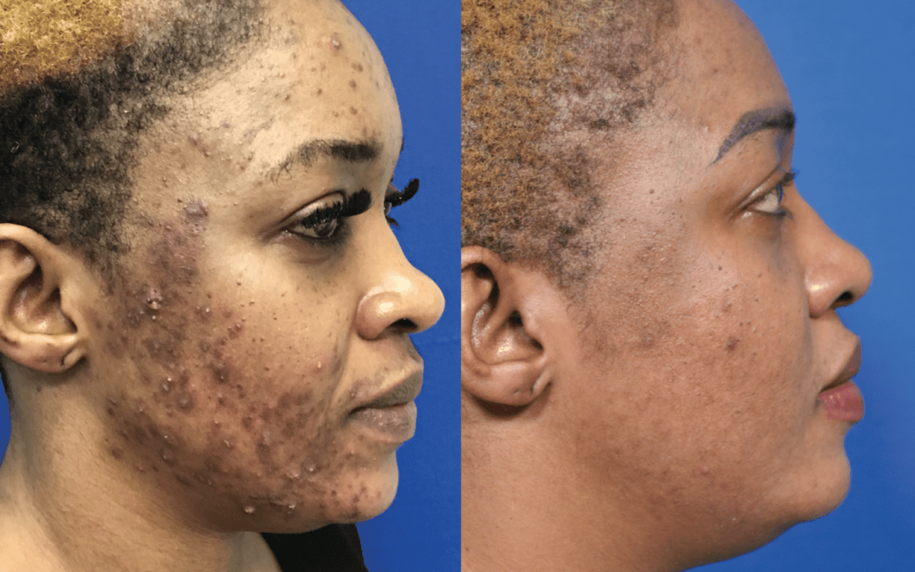 Acne And Acne Scarring Before And After Photo Gallery
