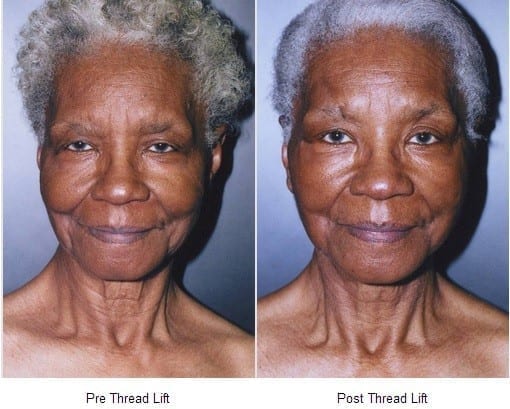 threading upper lip before and after