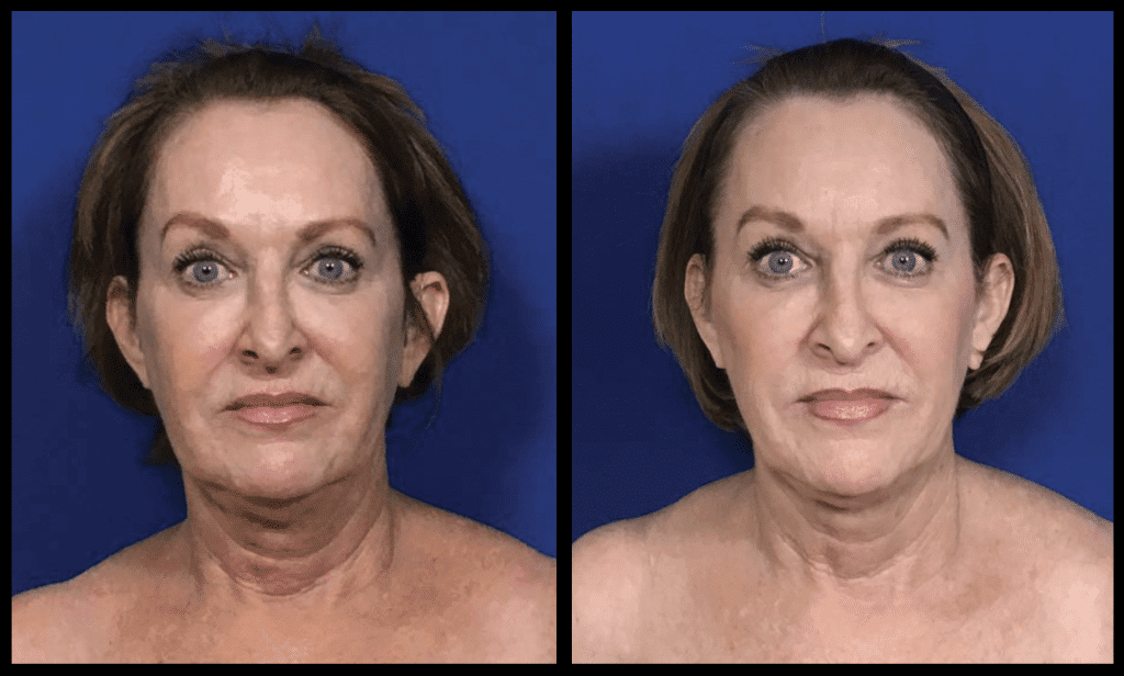 PDO Facial Threads In Utah, No Surgical Facelift