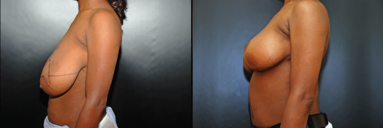 Breast-Reduction