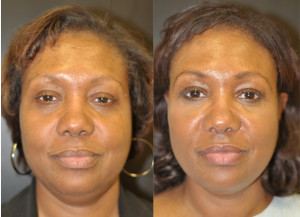 Injectable Fillers Baltimore Maryland