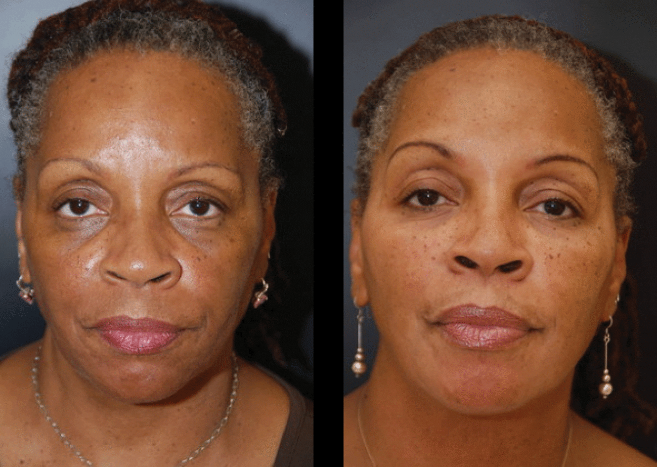 Injectable Fillers Baltimore Maryland