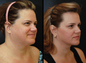 What is the cost of a facelift or neck lift?