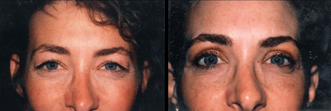 Eyelid Surgery n Baltimore Maryland | Dr. Dean Kane