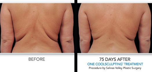 CoolSculpting Before and After 75