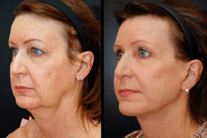 Mini-Facelift, Dr. Dean Kane, facelift