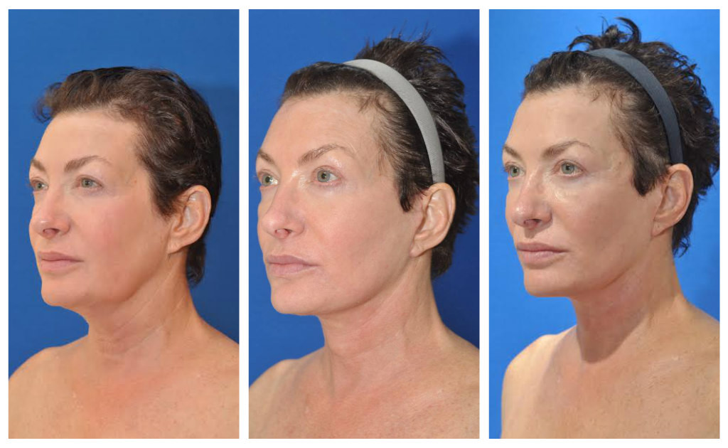 lauri prefacelift post facelift 4 months 1 yr