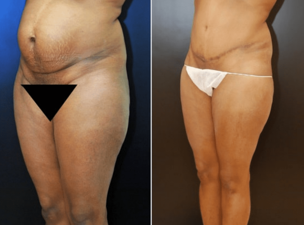 Why Is The Mons Pubis Puffy After Kids and/or Liposuction? Live