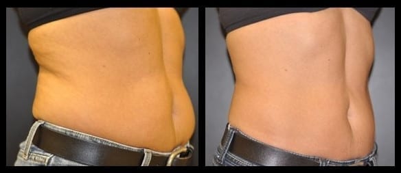 CoolSculpting Baltimore, MD, Owings Mills