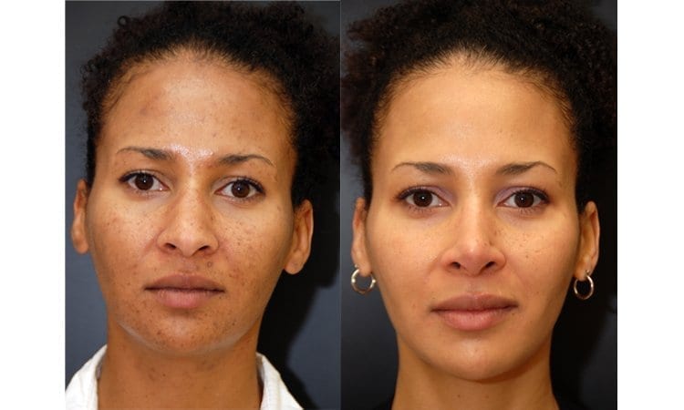 Acne Skin Care Before and After