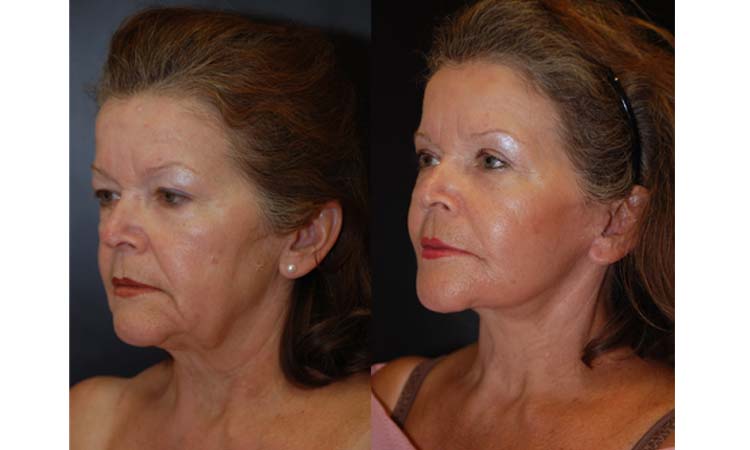 Traditional Face and Neck Lift
