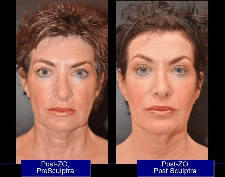 Sculptra in Baltimore Board Certified Dr. Dean Kane