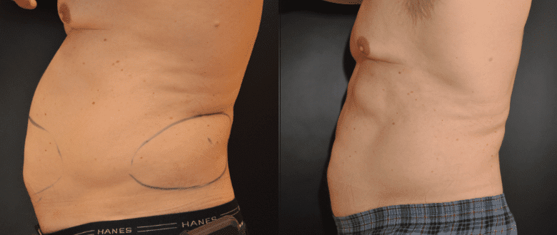 CoolSculpting Before & After Cases Baltimore MD | Pikesville