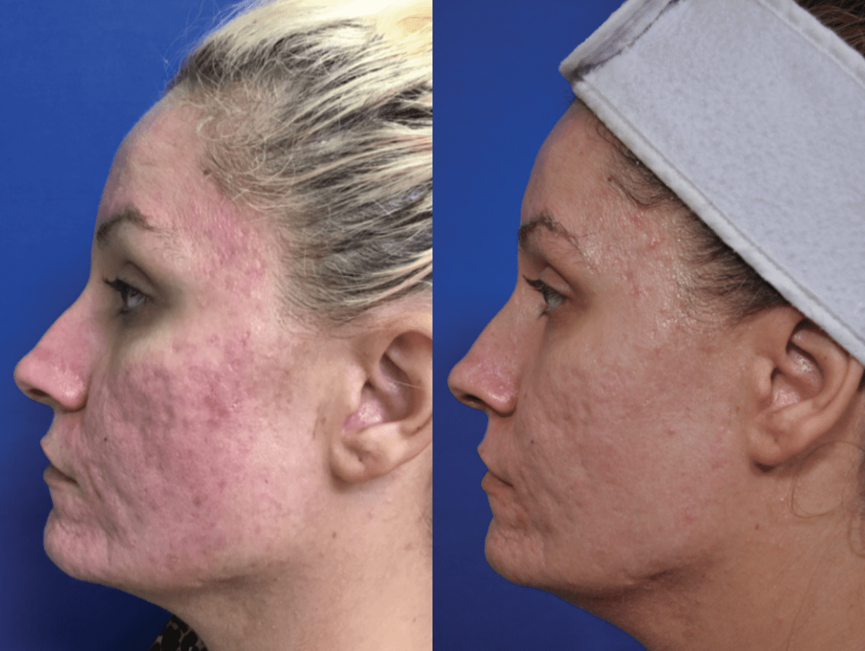 MicroNeedling with PRP Patient #1