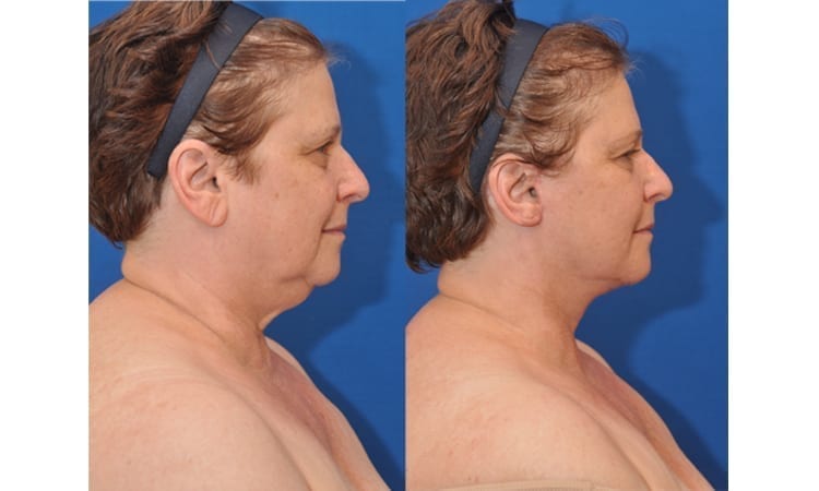 Traditional Face and Neck Lift
