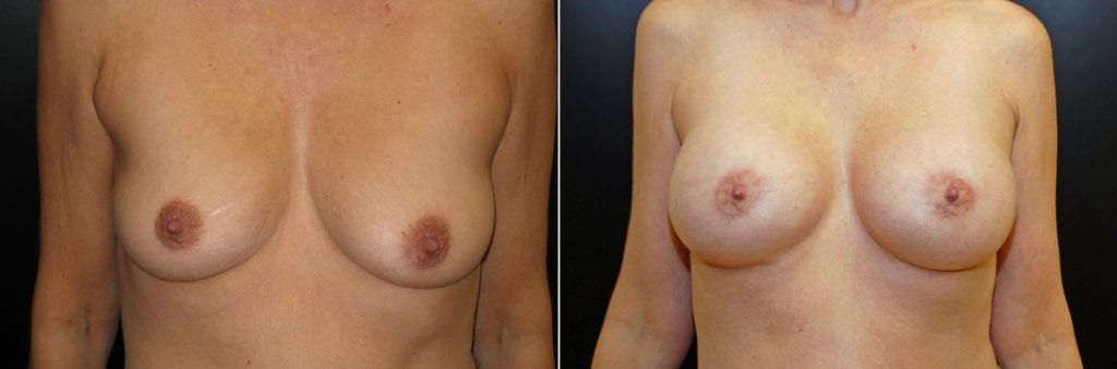 Breast Aug and Lift