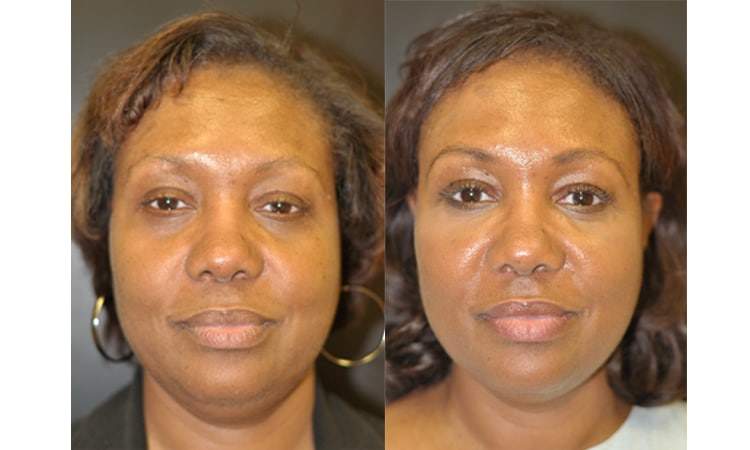 juvederm cheekbones