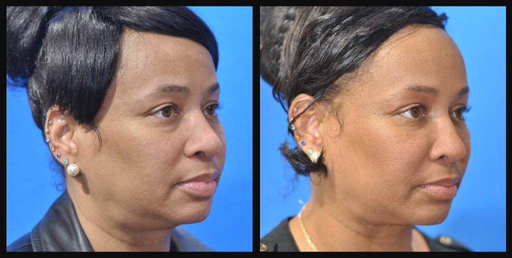 Dr. Dean Kane | Baltimore MD Face & Neck Lift