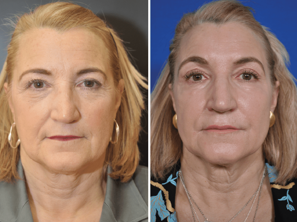 Sculptra Before & After