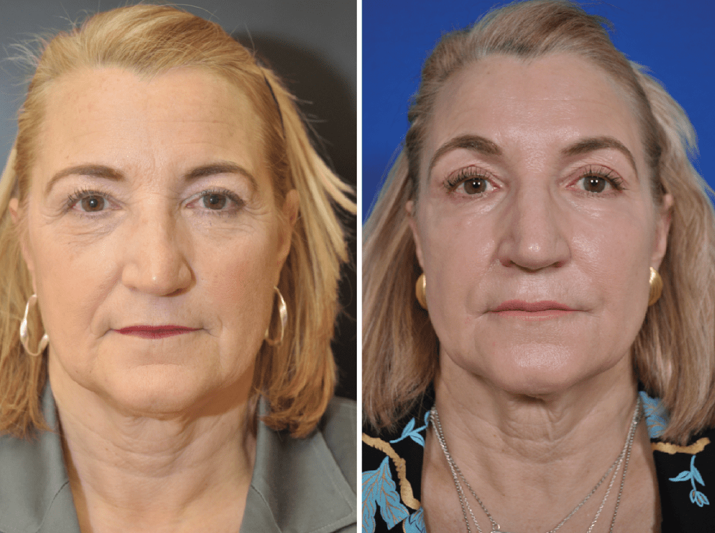 Treatment Suggestions for Deep Marionette Lines & Jowls | Dr. Dean Kane