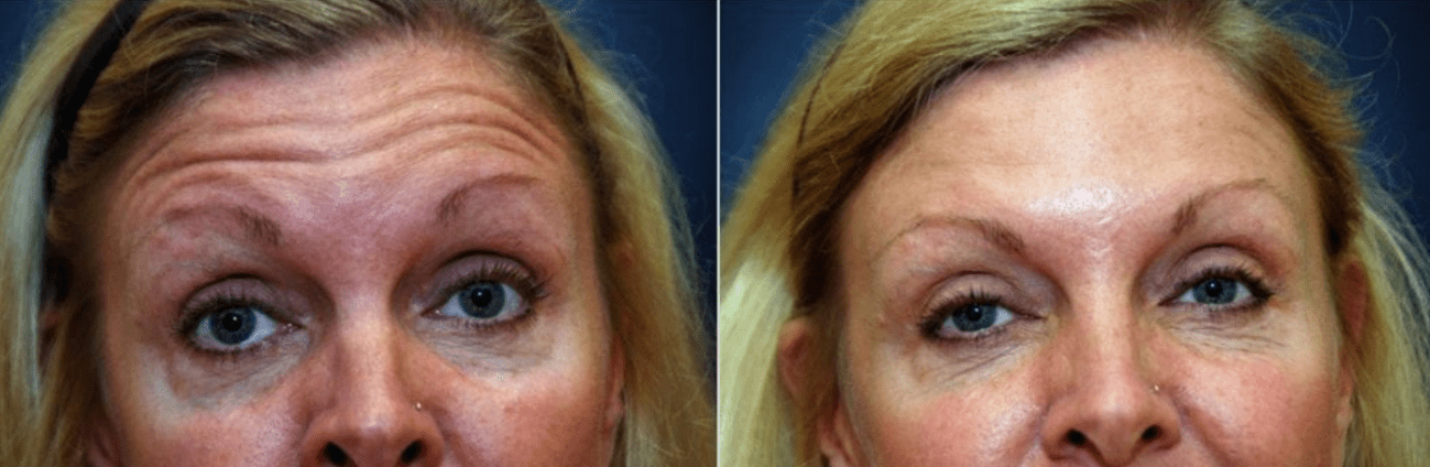 How Often Should I Get a Botox Touch-Up?