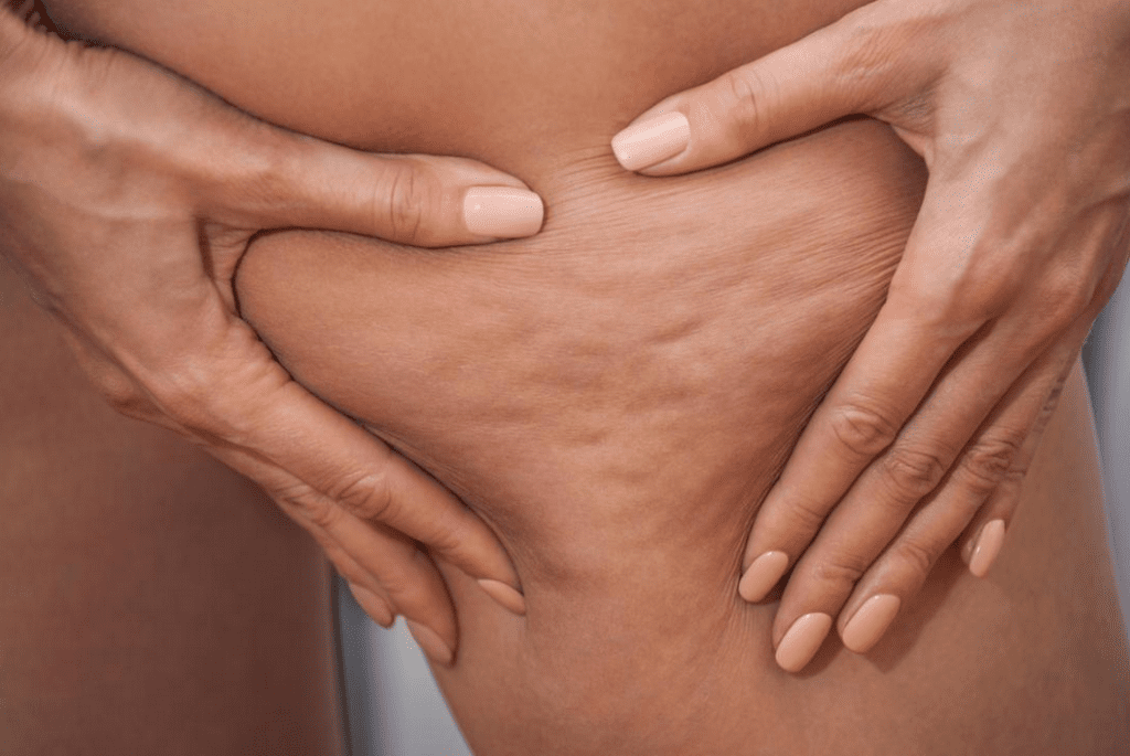 What Is Cellulite? - Baltimore, MD