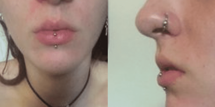 horizontal lip piercing scar
