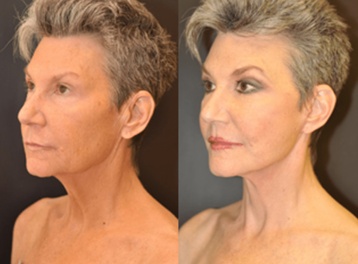 Mini Facelift Baltimore MD | Before & After