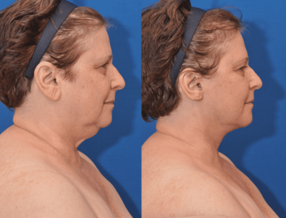 Neck Lift in Baltimore Maryland | Dr. Dean Kane