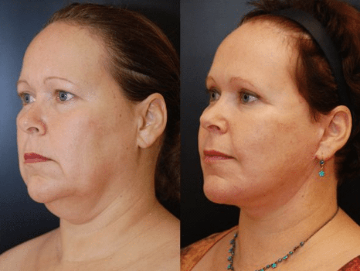 Neck Lift in Baltimore Maryland | Dr. Dean Kane