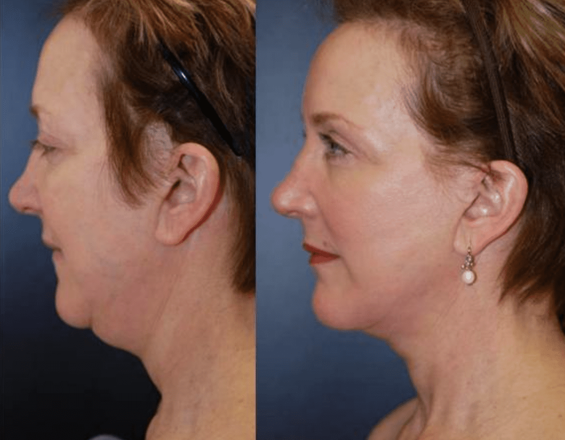 Neck Lift in Baltimore Maryland | Dr. Dean Kane