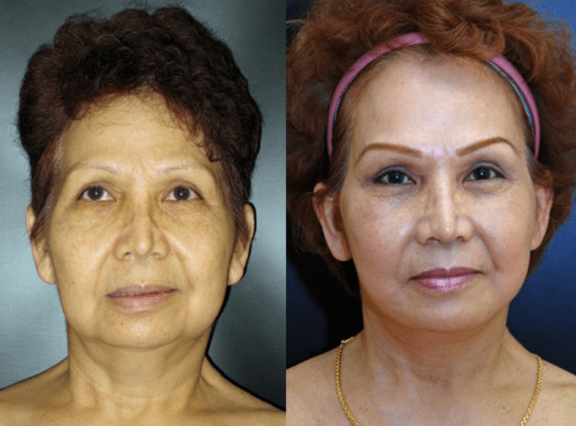 Facial Rejuvenation | Dr. Dean Kane, MD, FACS | Baltimore, MD