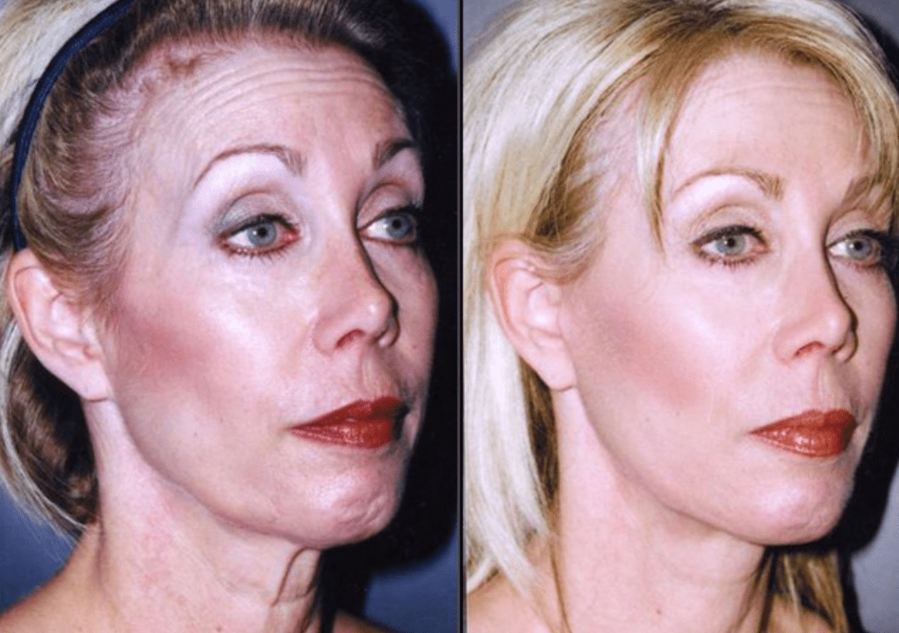 Mini Facelift Baltimore MD | Before & After