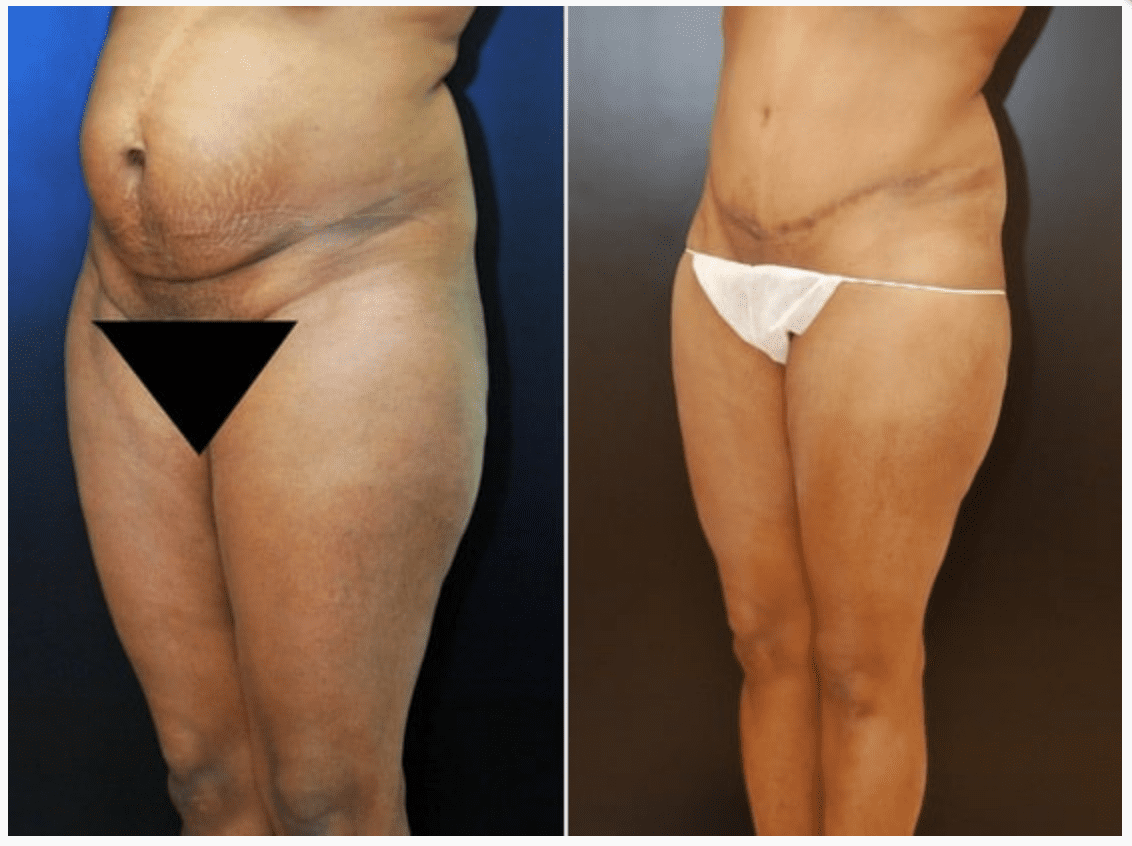 Tummy Tuck in Baltimore Maryland | Dr. Dean Kane