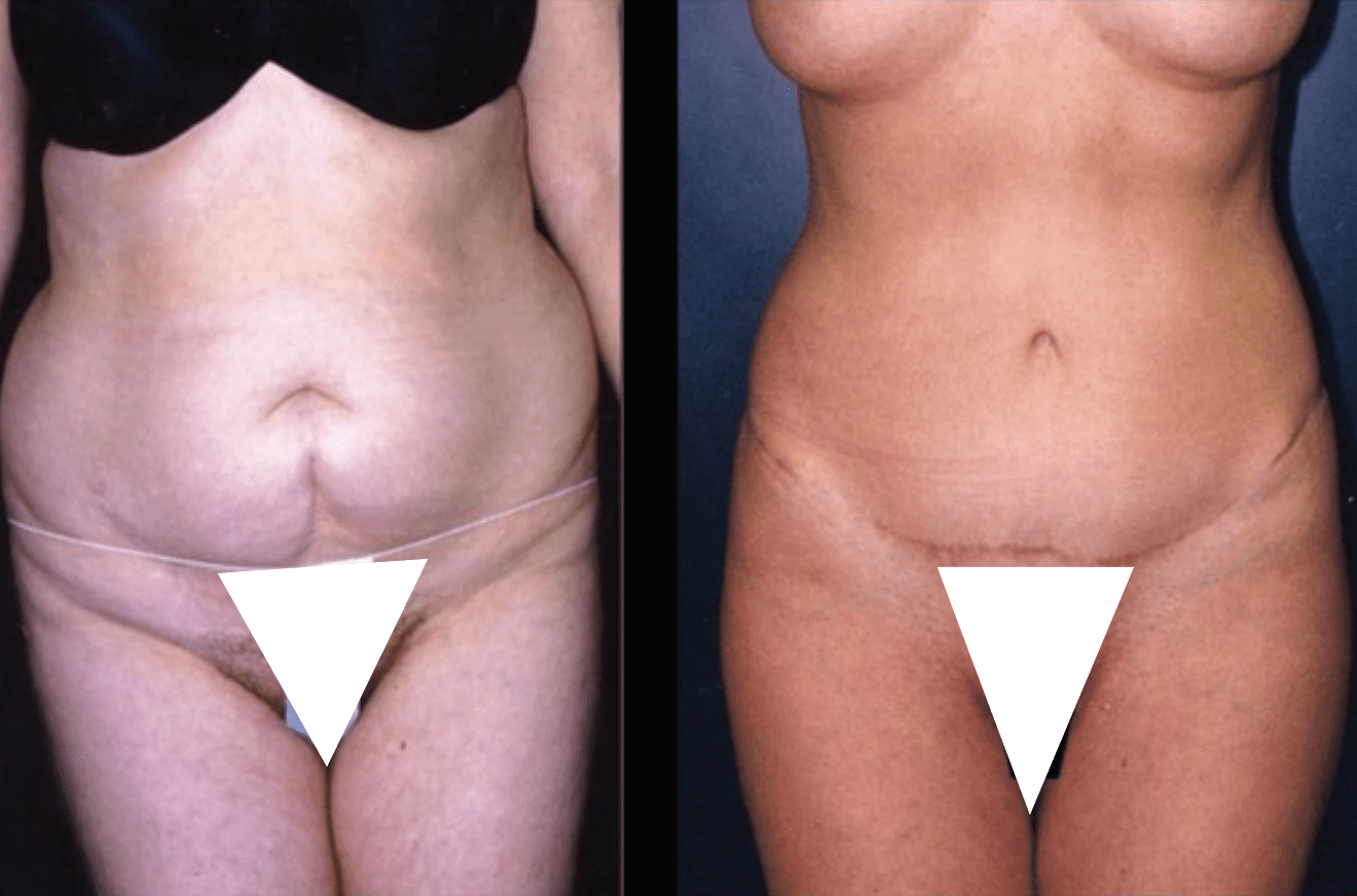 Tummy Tuck, Abdominoplasty