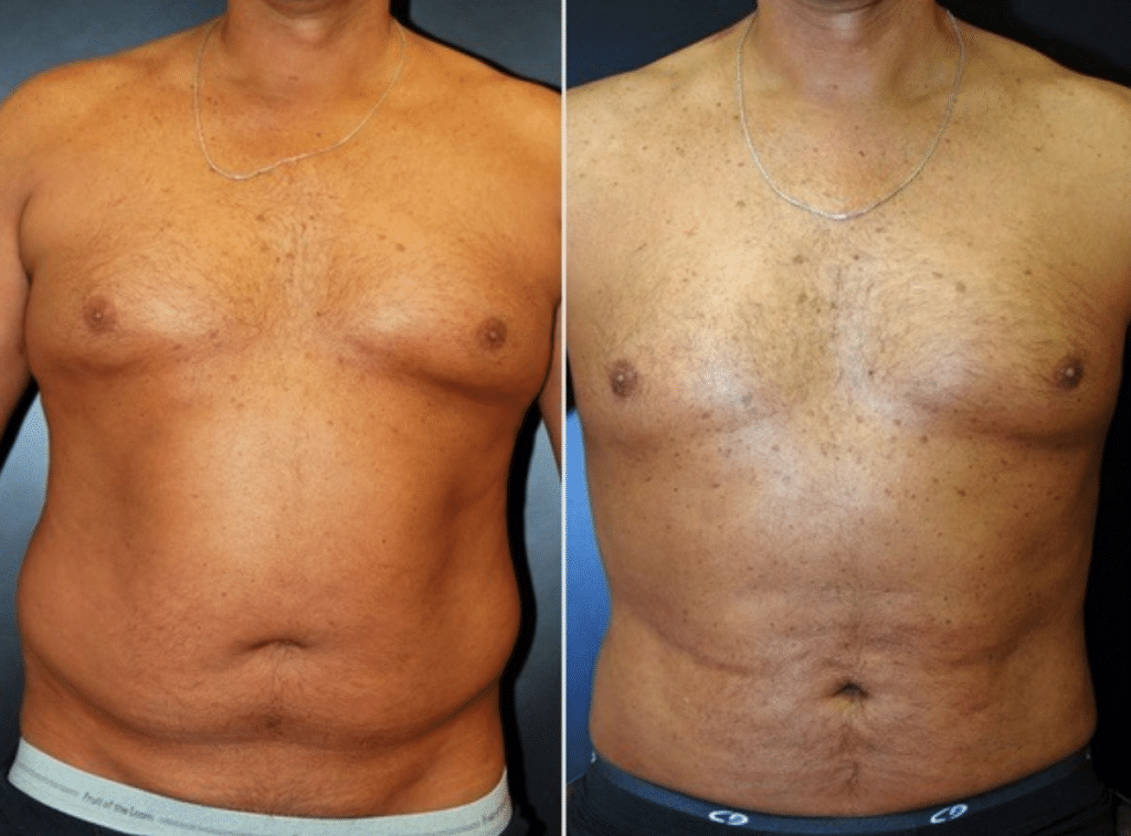 Liposuction in Baltimore Maryland | Dr. Dean Kane