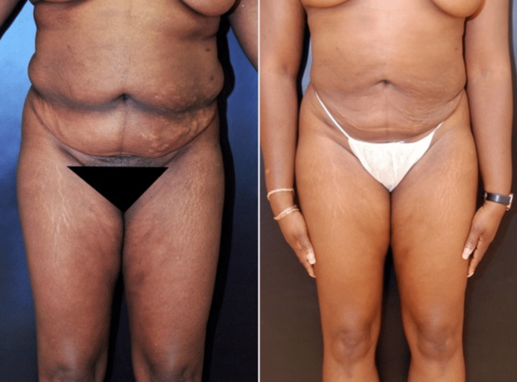 3,935 Liposuction Black Woman Images, Stock Photos, 3D objects, & Vectors