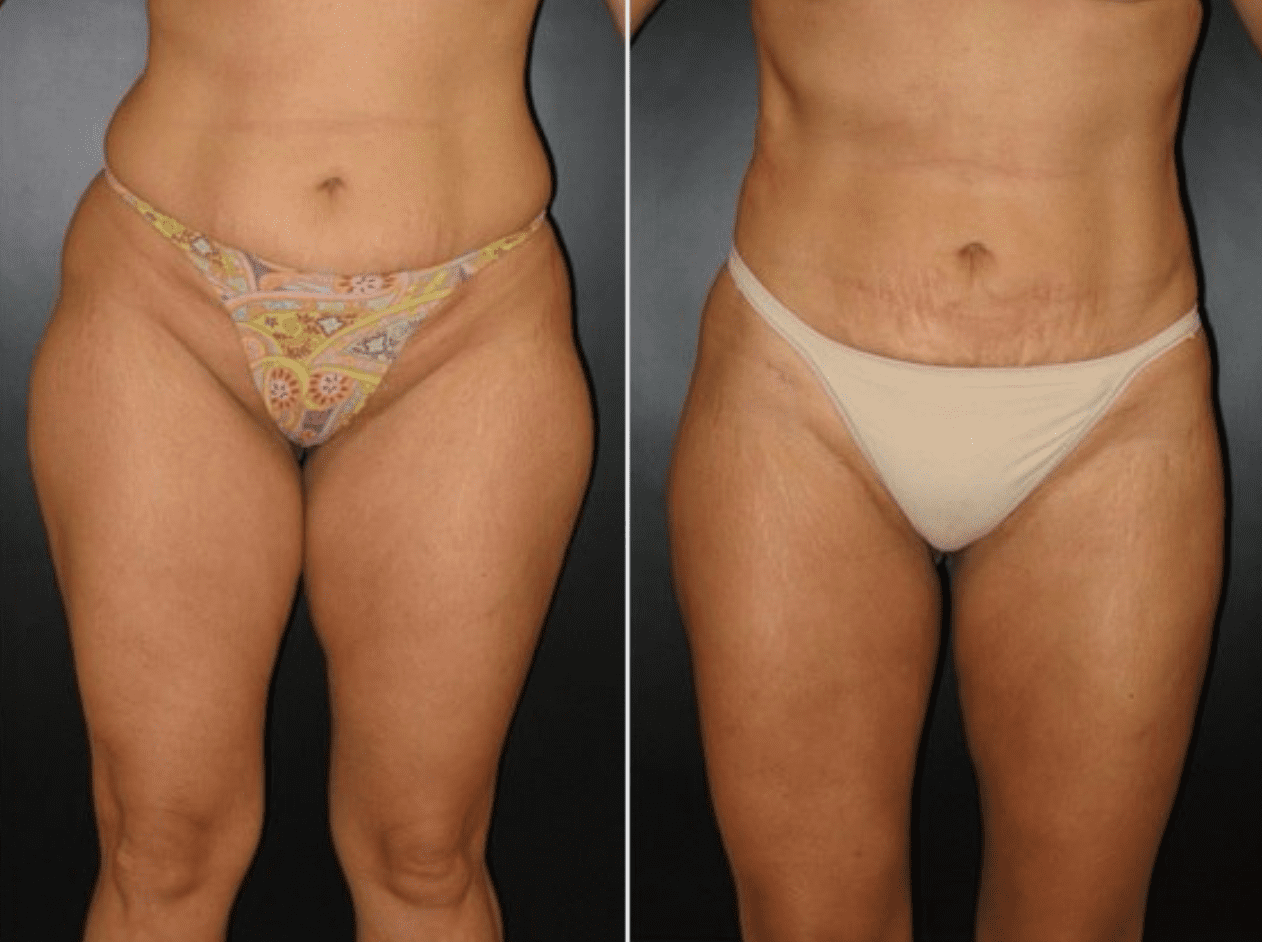 liposuction recovery tips