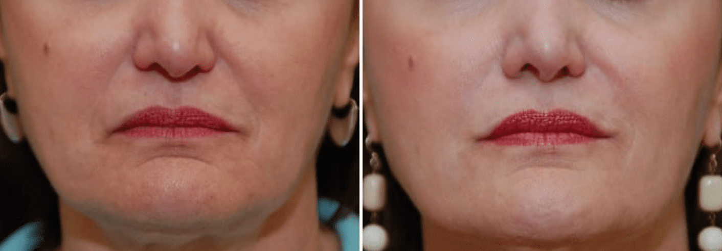 Botox Before & After #4