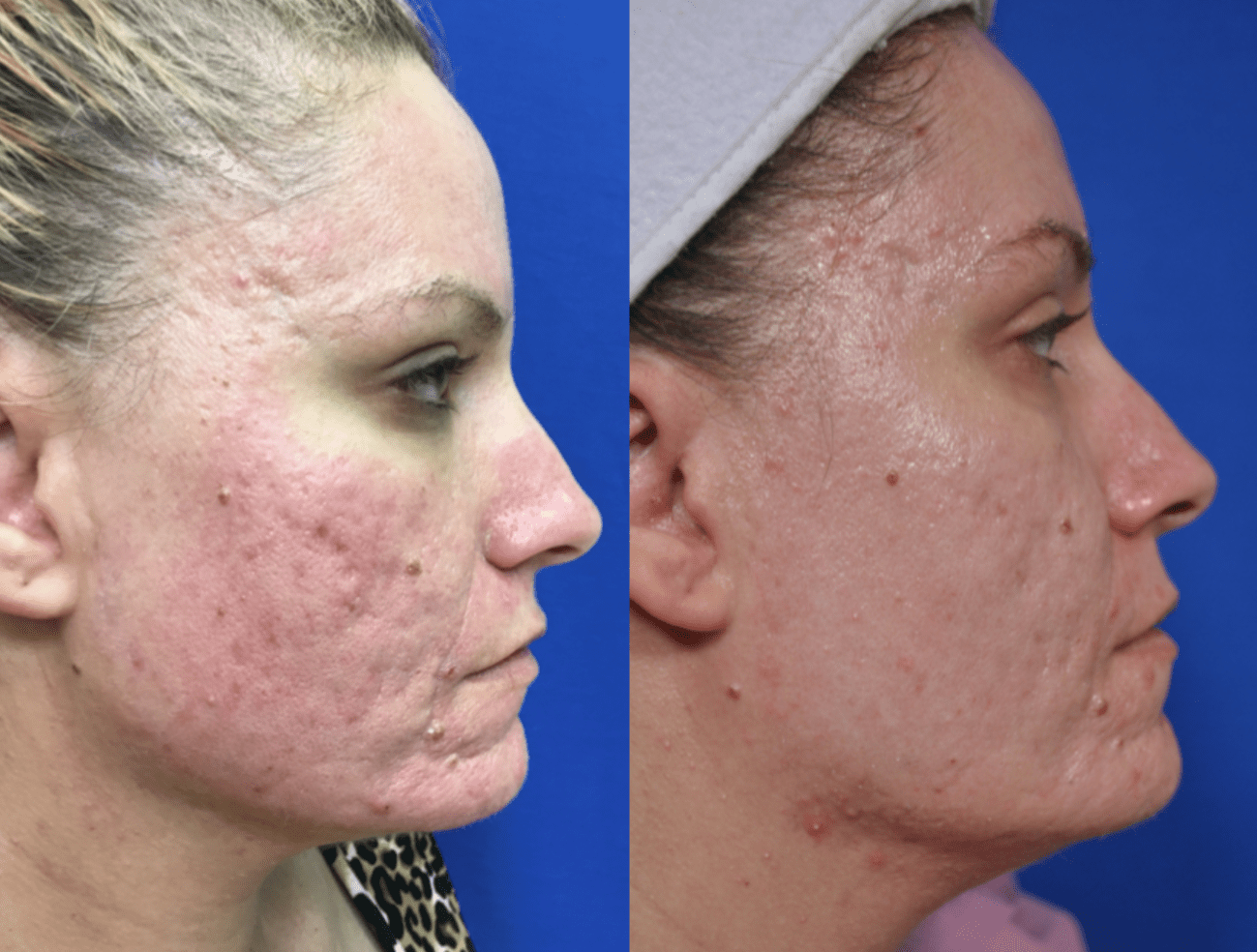 Acne Scar Treatments Before and After