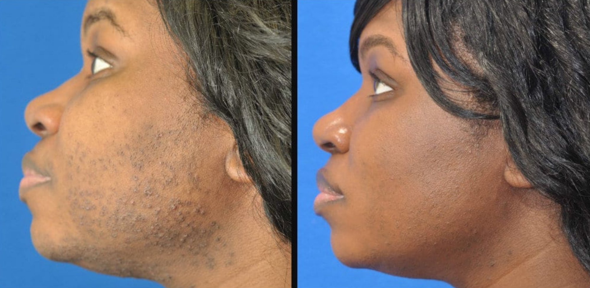 laser hair removal chin