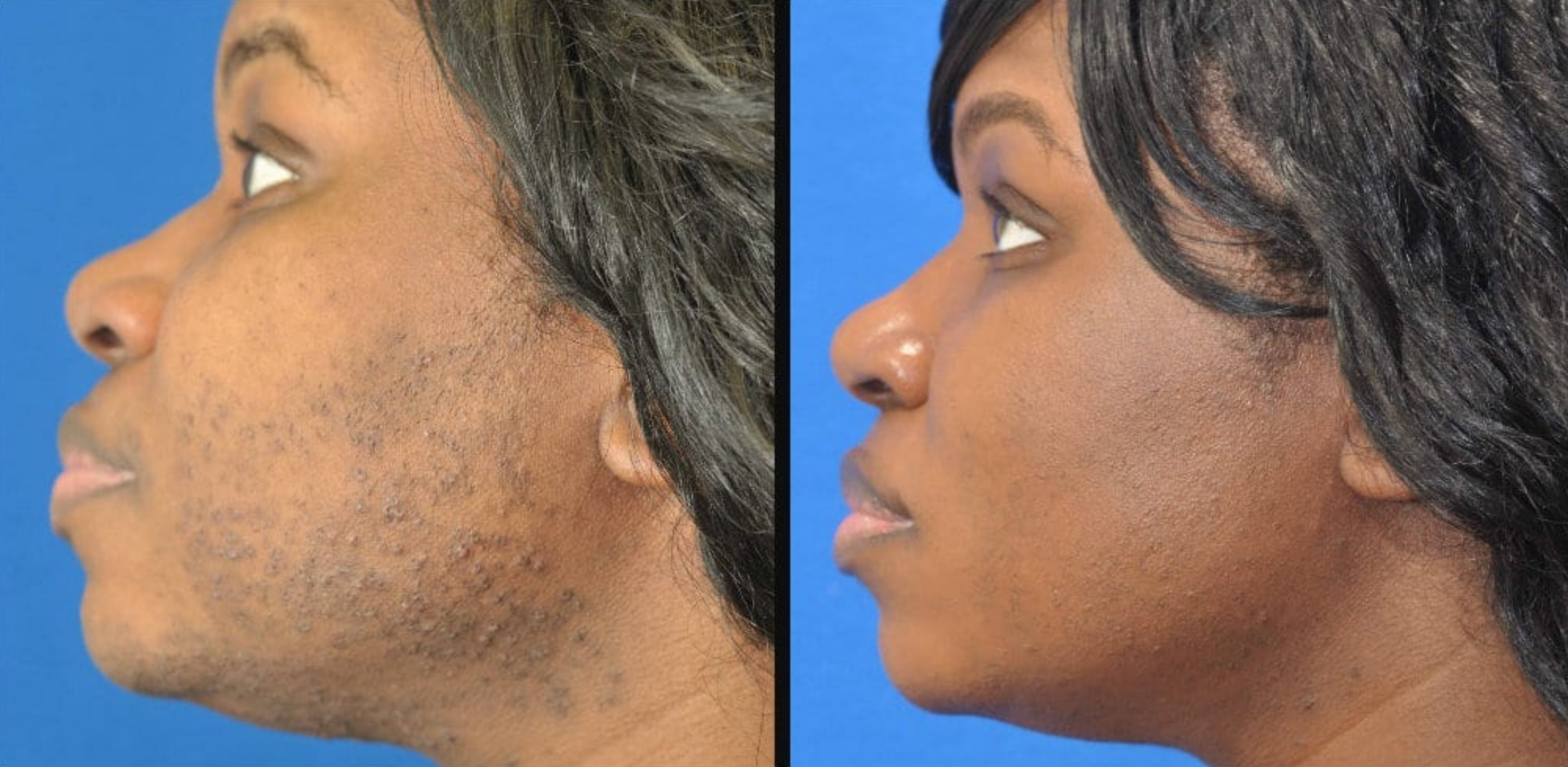 Facial Hair Removal Before And After At Katherine Edmunds Blog Facial Hair Removal Before And After At Katherine Edmunds Blog