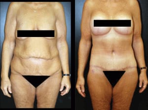 Body Lift, Center for Cosmetic Surgery & MediSpa