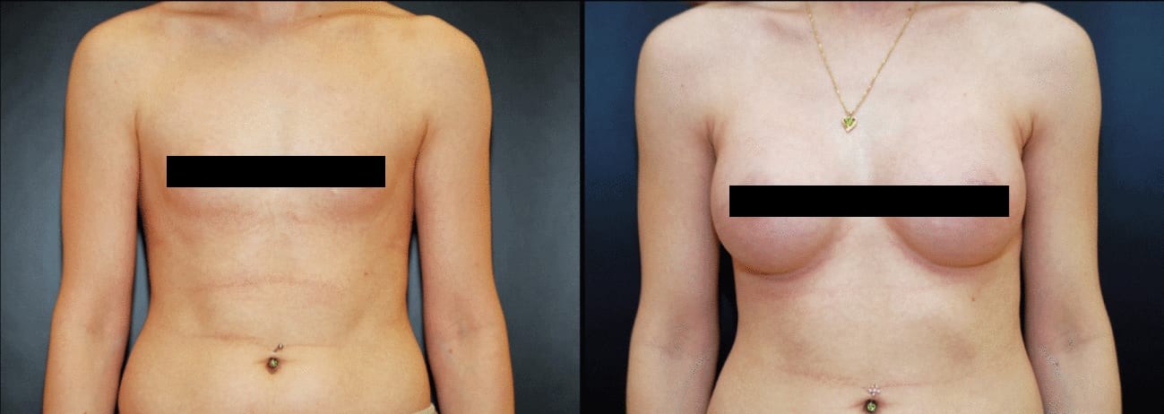Am I a Candidate for Breast Lift Surgery? - Allen, TX - North