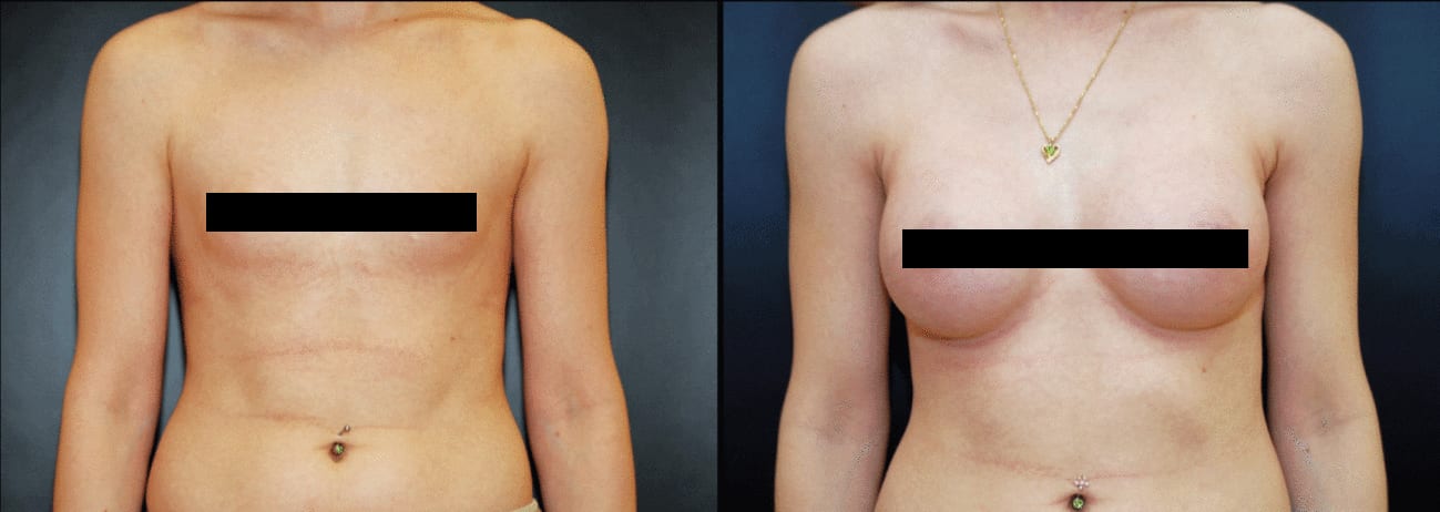 Do You Want a Natural Breast Augmentation? - Town & Country Plastic  Surgeons and Medspa